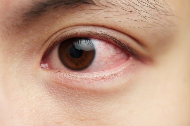 10 Penyebab Mata Kering dan Cara Mengatasinya - Alodokter