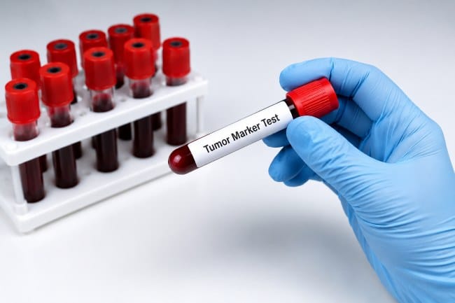 Rumah Sakit Terbaik untuk Tumor Marker - Alodokter