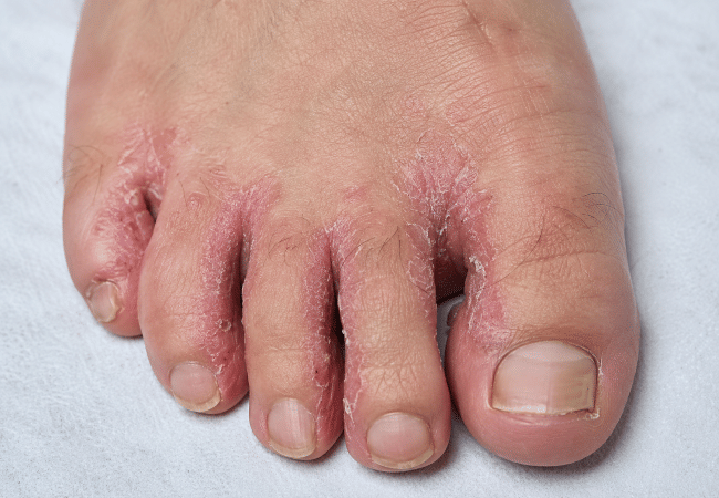 Jamur Kaki, Ketahui Penyebab, Gejala, dan Cara Mengatasinya - Alodokter