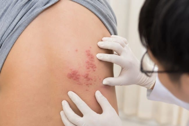 7 Perawatan Herpes Zoster yang Tepat untuk Mempercepat Pemulihan - Alodokter