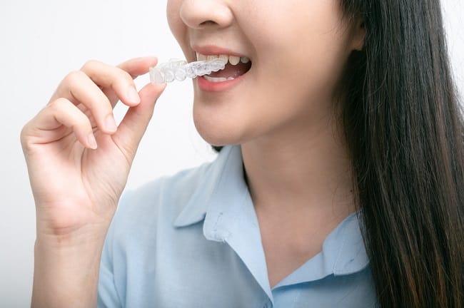 Retainer Gigi, Ini yang Harus Anda Ketahui - Alodokter